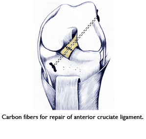 Carbon fiber repair of knee